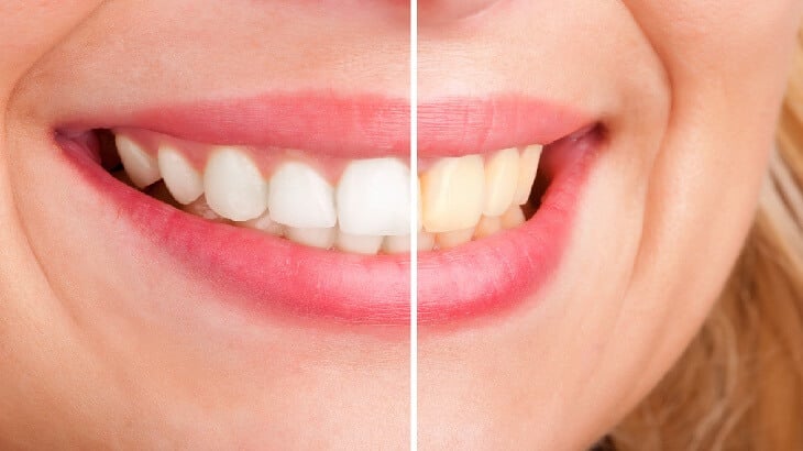 وصفات لتبييض الأسنان بالمكونات الطبيعية ونصائح للعناية بها