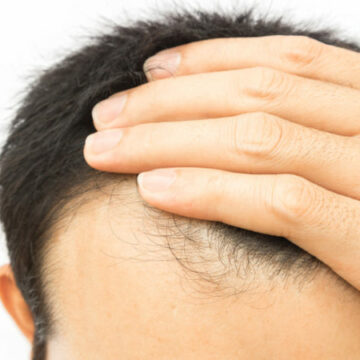 حقن البلازما .. أحدث تقنيات علاج الشعر والبشرة