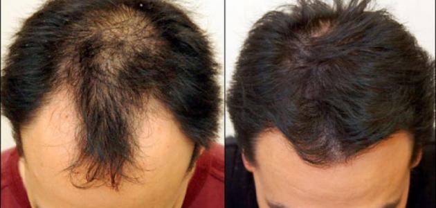 علاج نهائي لتساقط الشعر والفراغات وصفة سحرية بمثابة زرع طبيعي للشعر