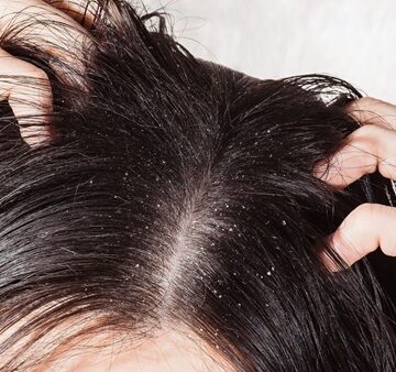 وصفة لتنعيم الشعر والتخلص من القشرة والحكة وأي أمراض بفروة الرأس