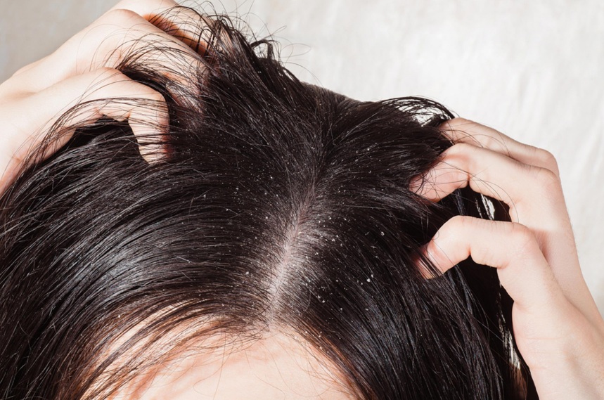 علاج قشرة الشعر بوصفات طبيعية بثلاث مكونات سحرية من مطبخك تخلصي منها للأبد