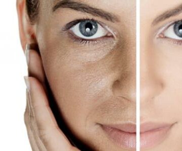 وصفات طبيعية لإزالة الكلف من الوجه بمكونات طبيعية وآمنة والحصول على بشرة نضرة