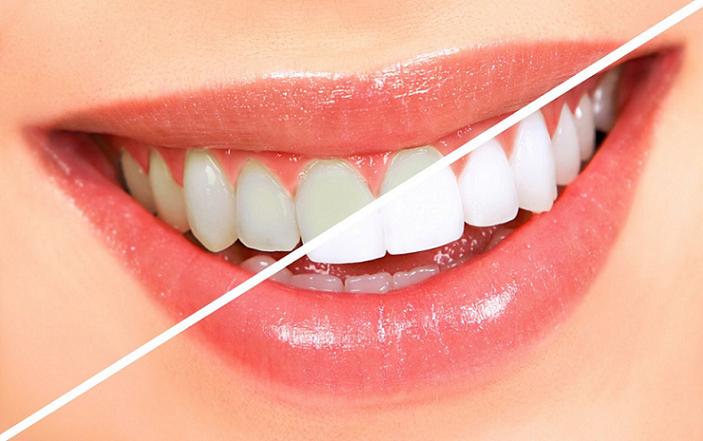 تمتعي بأسنان ناصعة البياض مع 10 وصفات طبيعية لتبييض الأسنان بالمنزل