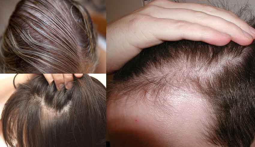 وصفة إماراتية لتطويل الشعر بنواة التمر تعمل على كثافة شعرك من الأمام والخلف من أول استخدام