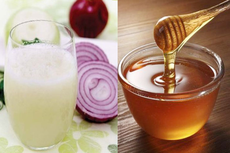 وصفة عصير البصل والعسل لتحفيز نمو الشعر ومنع التساقط