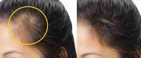 طرق إنبات الشعر في مقدمة الرأس… أقوى الوصفات لإنبات الشعر بسرعة