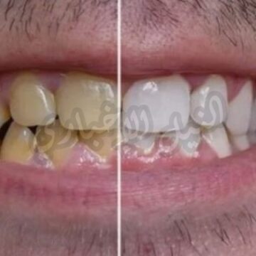 طرق مذهلة مجربة لتبييض الأسنان الصفراء طبيعياً بسرعة غير متوقعة