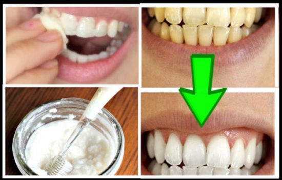 تبييض الأسنان وإزالة الاصفرار بوصفة طبيعية من داخل منزلك غير مكلفة