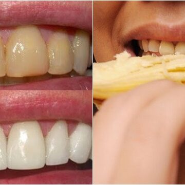 طريقة استخدام قشر الموز لتبييض الأسنان في دقائق