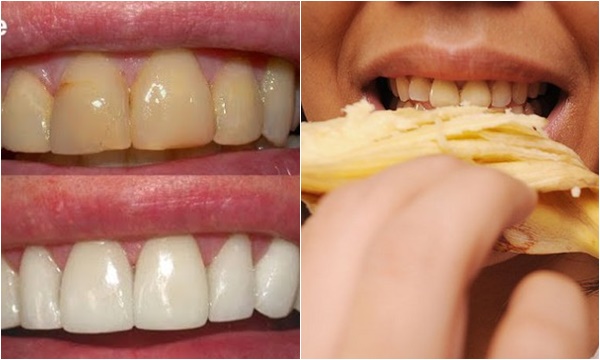 طريقة استخدام قشر الموز لتبييض الأسنان في دقائق