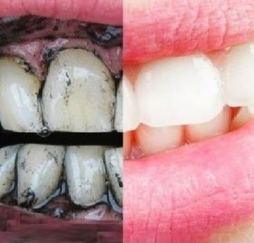 خلطة تبييض الأسنان بالفحم