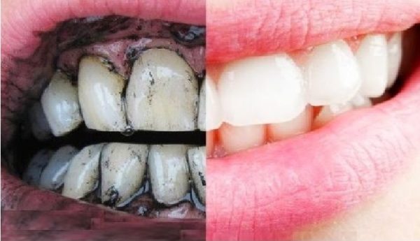 خلطة تبييض الأسنان بالفحم