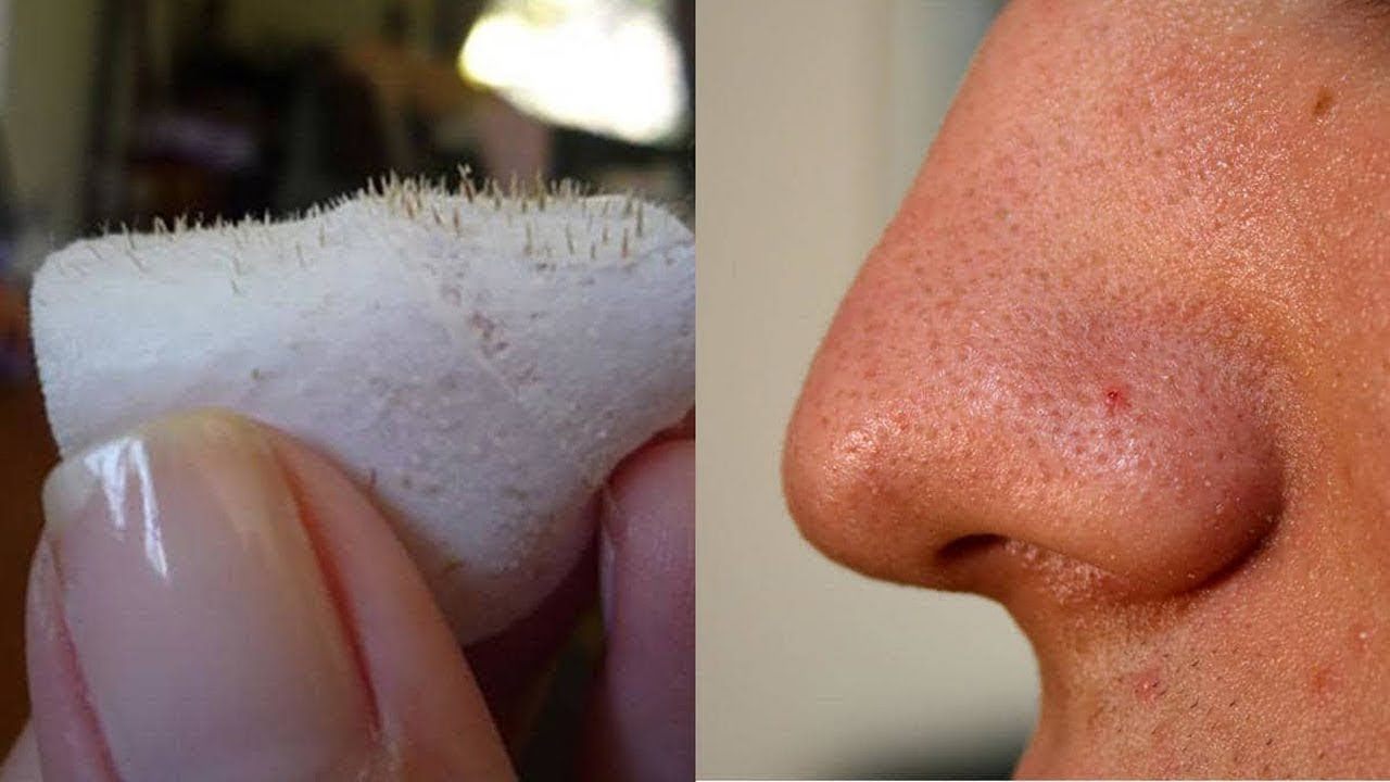 إزالة الرؤوس السوداء من الوجه نهائياً بالبخار بدون كريمات أو تقشير أو ألم وصفة فعالة ومجربة