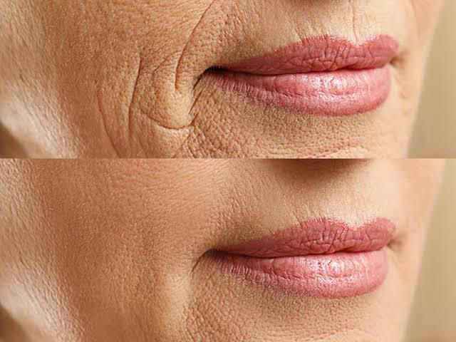 وصفات للتخلص من تجاعيد الوجه… واسترجاع بشرتك في العشرينات