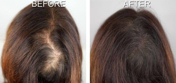 خلطات لإيقاف تساقط الشعر في 7 أيام وإعادة إنبات الفراغات بمكونات طبيعية من منزلك بأقل التكاليف