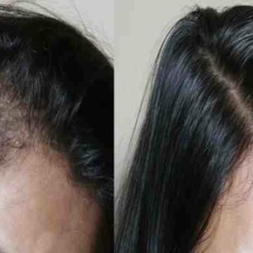 علاج تساقط الشعر بأفضل وسيلة طبيعية لمنع التساقط في أسبوع وإعادة إنبات الفراغات