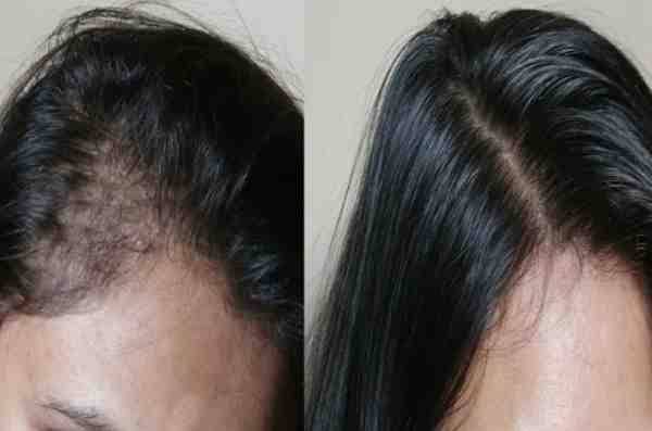 علاج تساقط الشعر بأفضل وسيلة طبيعية لمنع التساقط في أسبوع وإعادة إنبات الفراغات