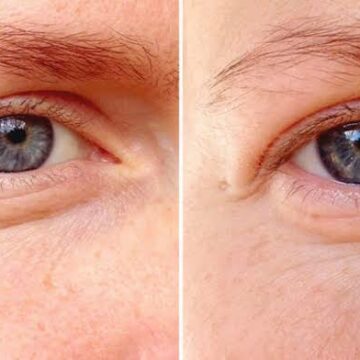 وصفات إزالة التجاعيد والخطوط الدقيقة من أسفل العينين لبشرة ناعمة ومشدودة هتصغرك عشرين سنة