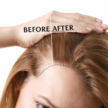 علاج تساقط الشعر في أسبوع مع الحل الفعال لمنع التساقط وتكثيف شعرك وزيادة طوله