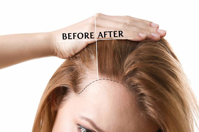 علاج تساقط الشعر في أسبوع مع الحل الفعال لمنع التساقط وتكثيف شعرك وزيادة طوله