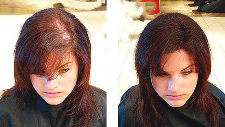 دراسة حديثة تكشف عن حيلة سهلة وغير متوقعة لإيقاف تساقط الشعر وحماية فروة الرأس من الفراغات