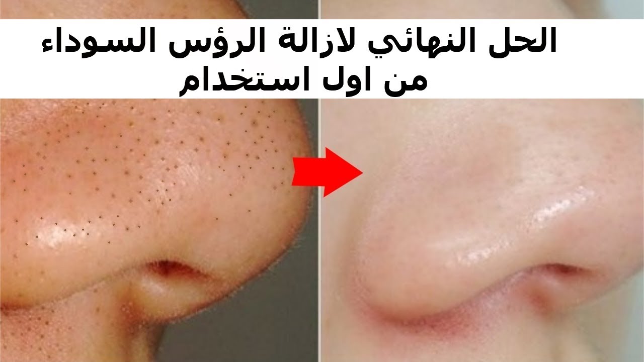 إزالة الرؤوس السوداء من الوجه بخلطة سحرية فعالة 100% ومن أول استخدام لن تصدق النتيجة