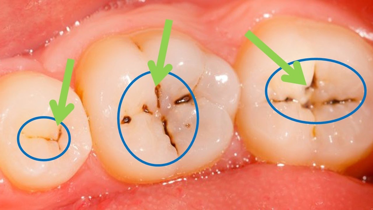 التخلص من تسوس الأسنان بمكون طبيعي واحد فقط متواجد في كل منزل ووداعًا للمواد الكيميائية