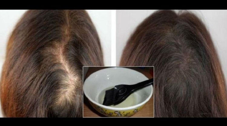 خلطات طبيعية لطرق إنبات الشعر وعلاج فراغات مقدمة ووسط الرأس