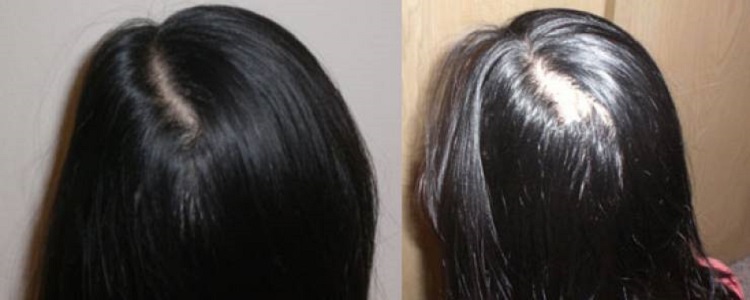 طرق طبيعية لعلاج فراغ الشعر بالأعشاب وأفضل الوصفات الطبيعية لإنبات الشعر مرة أخرى