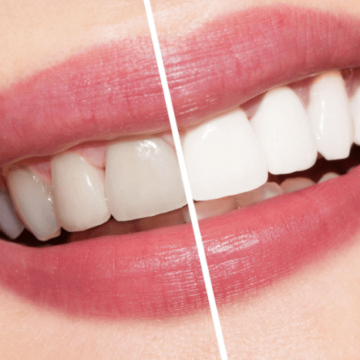 تبييض الأسنان قد لا تصدق ذلك ولكن هناك طرق طبيعية لجعل الاسنان ناصعة البياض في المنزل