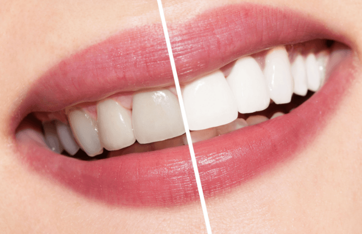 تبييض الأسنان قد لا تصدق ذلك ولكن هناك طرق طبيعية لجعل الاسنان ناصعة البياض في المنزل