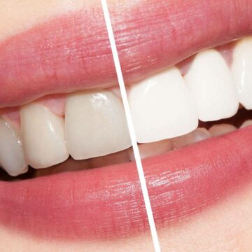 وصفات طبيعية لتبييض الأسنان والقضاء على الاصفرار ولابتسامة مليئة بالثقة بمكونات موجودة في مطبخك 