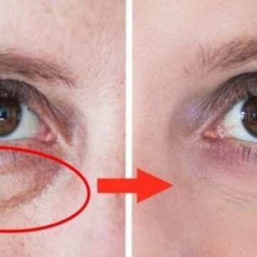 علاج الهالات السوداء في 4 خطوات بالمنزل لعيون ساحرة ستبهرك وبشرة روعة بدون سواد أو بقع داكنة