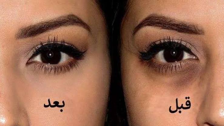 علاج الهالات السوداء المضمون: ضعيها 30 دقيقة تحت العين النتيجة ستبهرك عيون ساحرة بدون سواد أو انتفاخ