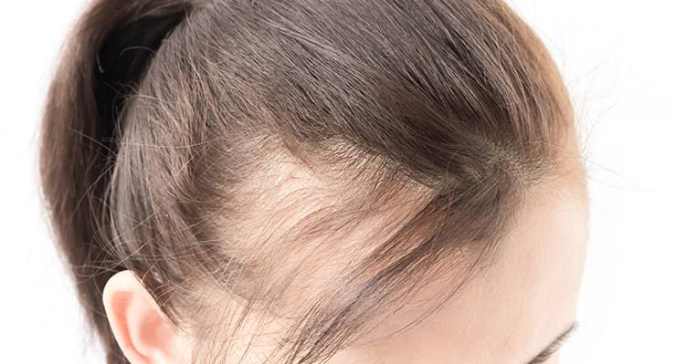 شعرك سيصبح كثيف وقوي.. طرق مختلفة لعلاج مشكلة فراغات الشعر ومنع التساقط وإنبات الفراغات نتيجة مضمونة