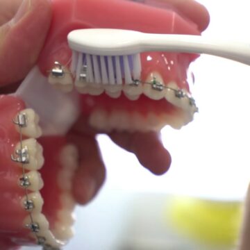 طريقة تنظيف تقويم الأسنان بشكل سليم ونصائح يجب اتباعها عند تنظيفه
