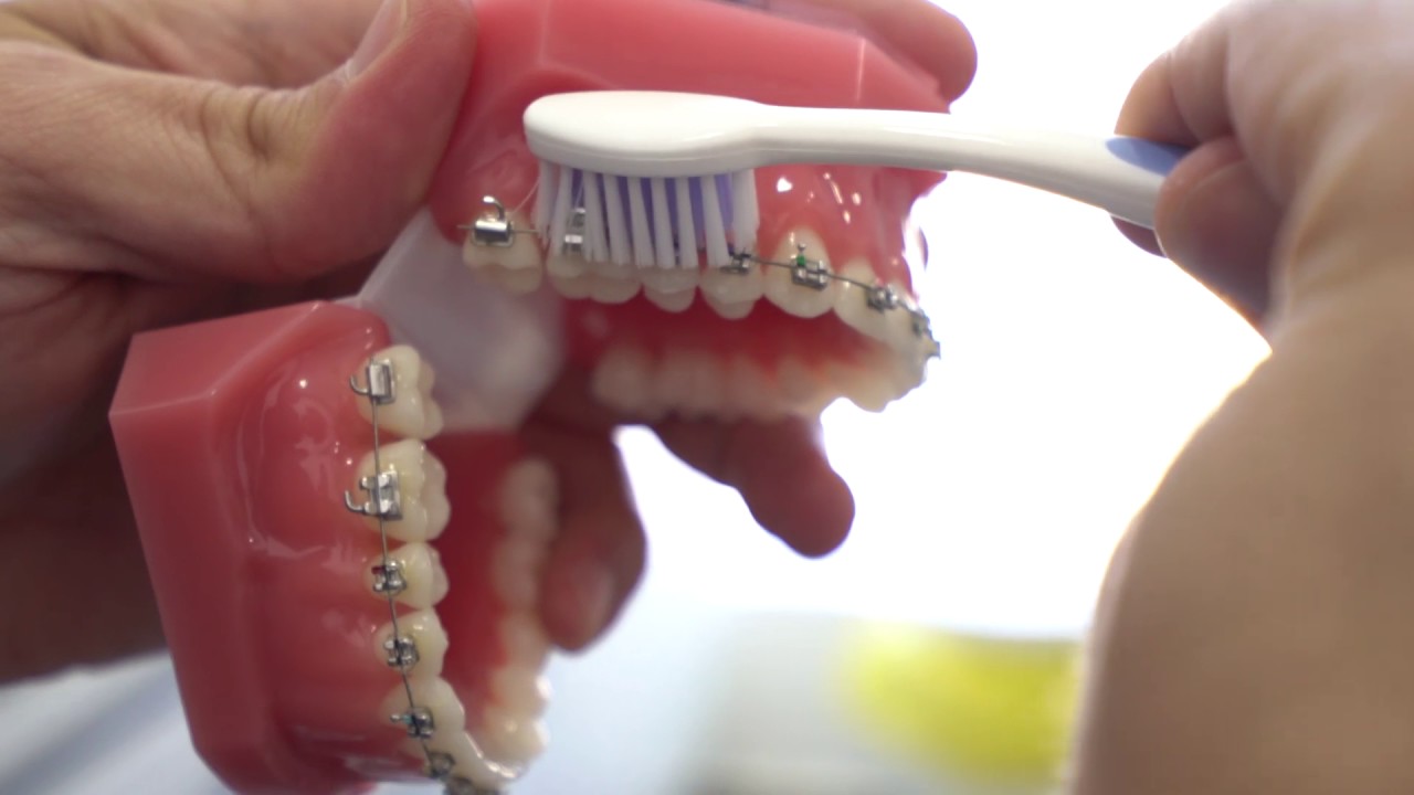 طريقة تنظيف تقويم الأسنان بشكل سليم ونصائح يجب اتباعها عند تنظيفه