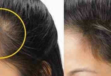 طريقة طبيعية لإنبات الشعر… أقوى وأسرع الوصفات لعلاج تساقط الشعر وإنبات الفراغات