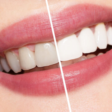 تبييض الأسنان في 5 دقائق..بوصفات طبيعية ستبهرك النتيجة