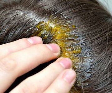 وصفات طبيعية لعلاج تساقط الشعر في المنزل والقضاء على هذه المشكلة تماماً بالمكونات الطبيعية 