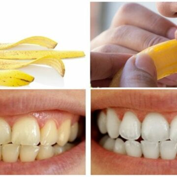 قشر الموز لتبييض الأسنان وداعًا لجلسات التبييض مرة أخرى والنتيجة فعالة من أول مرة