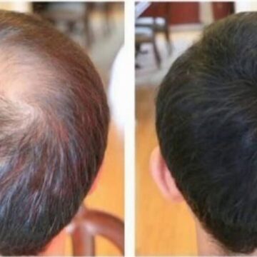 وصفة ورق الجوافة لتكثيف الشعر وإيقاف التساقط استخدميه بهذه الطريقة ولن يسقط شعرك مجددا