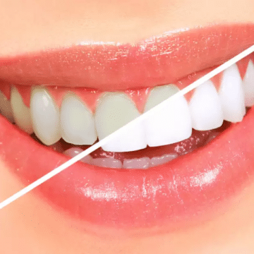 وصفات طبيعية تساعد في تفتيح الأسنان في المنزل