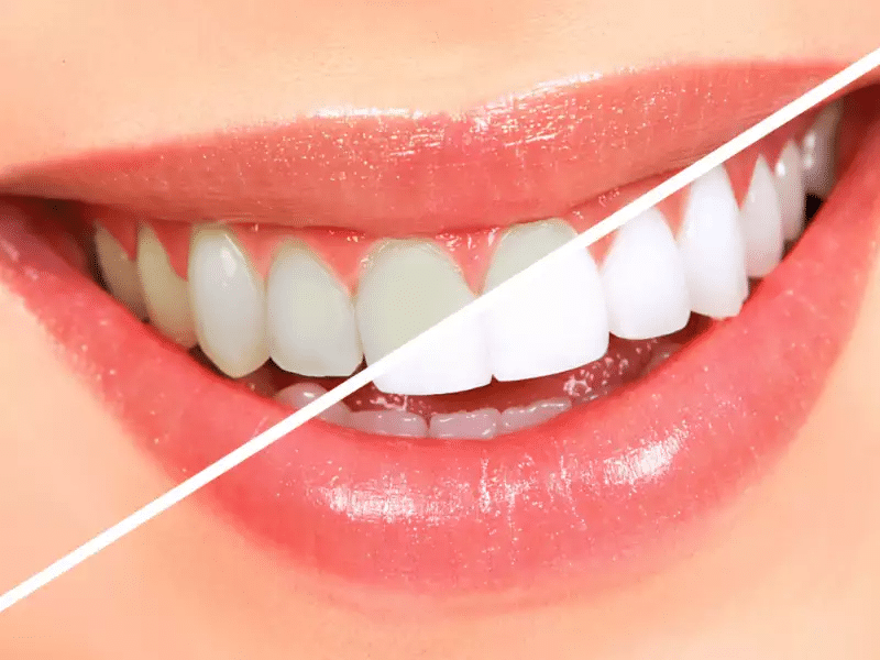وصفات طبيعية تساعد في تفتيح الأسنان في المنزل
