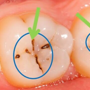 خلطة فعالة ومجربة لإزالة تسوس الأسنان والجير المتراكم وتسكين الآلام النتائج عن تسوس الضرس