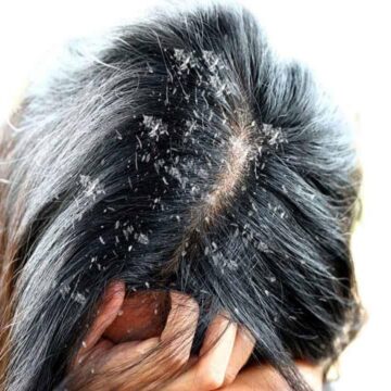أرخص وصفات التخلص من قشرة الشعر باستخدام الملح
