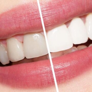اسهل واسرع طريقة للتخلص من صفار الاسنان وإزالة الجير بمكونات من البيت