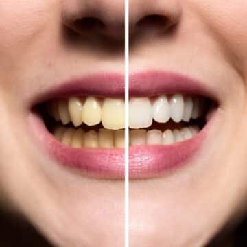 وصفة طبيعية لتبييض الأسنان من الاصفرار والتخلص من الجير نهائيا