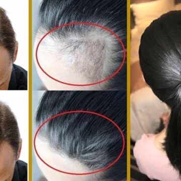 خلطة علاج فراغات الشعر وملئ وتكثيف مقدمة الرأس بسرعة جداً