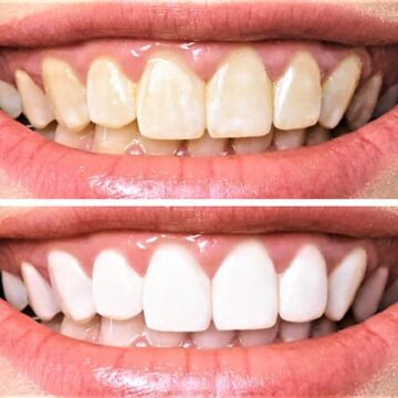 لأسنان بيضاء كاللؤلؤ استخدمي خلطة القرنفل لتبييض الاسنان وازالة الجير والاصفرار نهائياً
